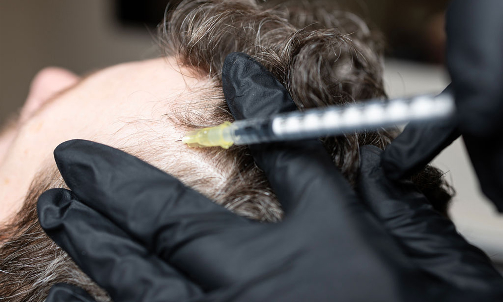 I-PRF is an advanced, autologous, regenerative treatment for hair loss.